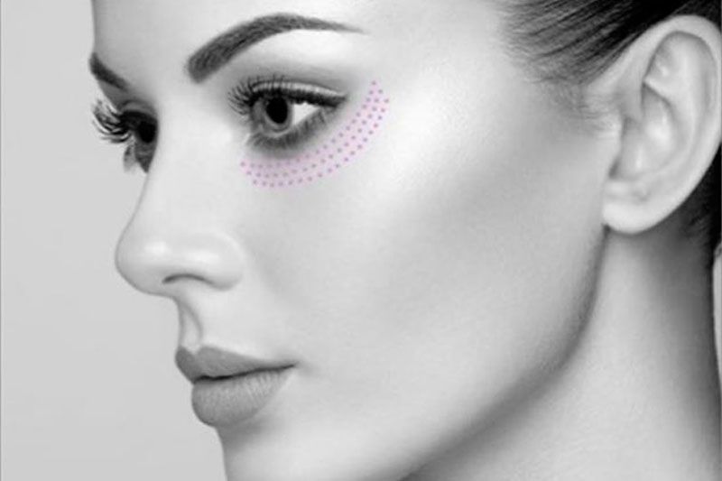 Tratamientos Plasmapen - CC Laser Depilacion Tratamientos Plasmapen